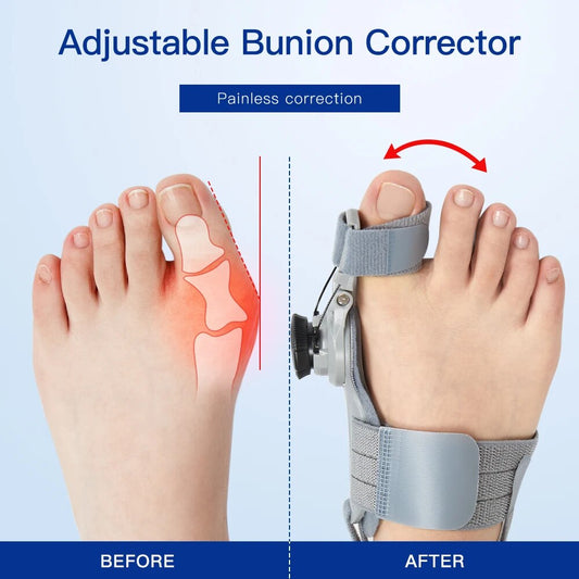 Correct your bunions without pain or surgery 